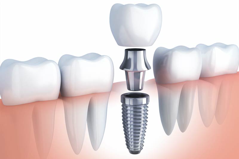 Implants Dentist in Denver