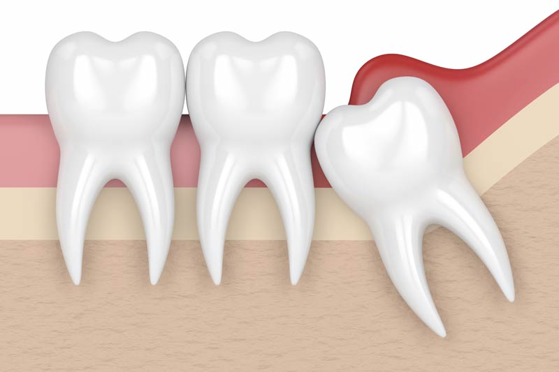 Wisdom Tooth Removal in Denver